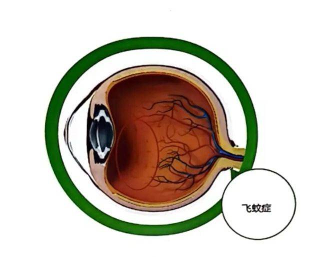 飛蚊癥治療最新突破，開(kāi)啟視界新篇章